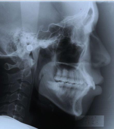 Print on transparent support LATERAL SKULL RADIOGRAPH BEFORE TREATMENT