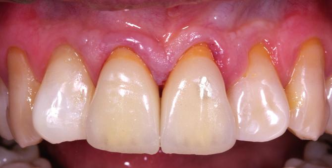 bond. Combined with the enhanced physical properties and higher degree of conversion, this results in a stronger and more durable bond to zirconia without the need for a