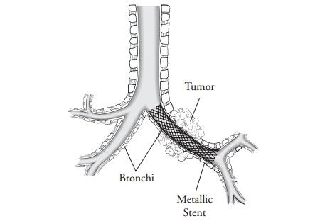 PATIENT & CAREGIVER EDUCATION Tracheal or Bronchial Stent Placement This information will help you prepare for your tracheal or bronchial stent placement at Memorial Sloan Kettering (MSK).