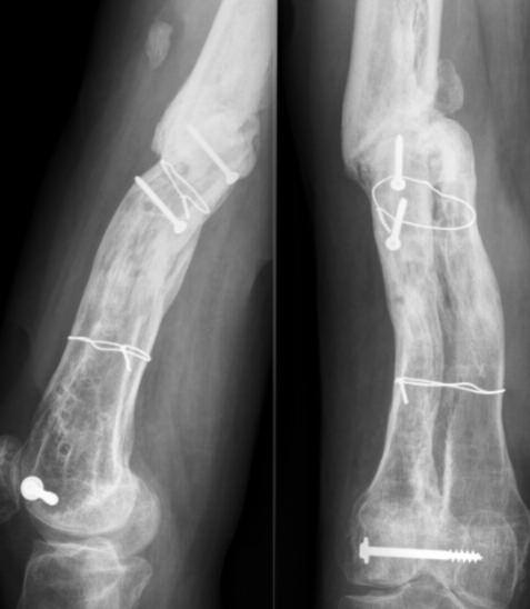 5 cm shortening (a) treated with compression at level of non-union and distal distraction (b).