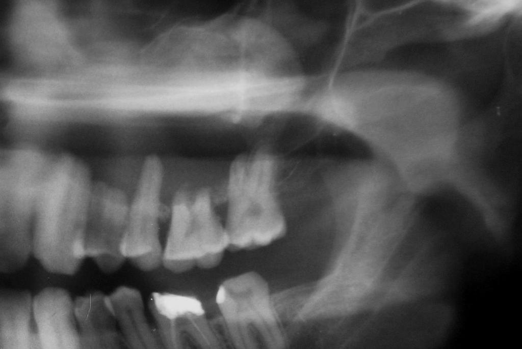 igure 2: Cropped panoramic radiograph revealing well defined unilocular with