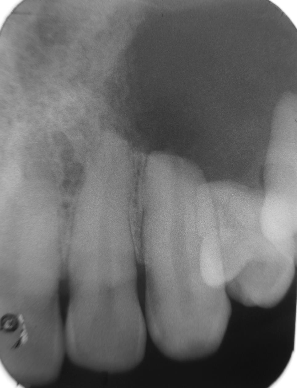 igure 3: Intraoral periapical radiograph with respect to 22, 23, 24, 25 showing