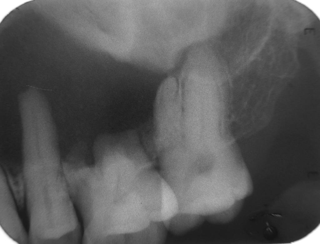 igure 4: Intraoral periapical radiograph with respect to 25, 26, and 27 showing
