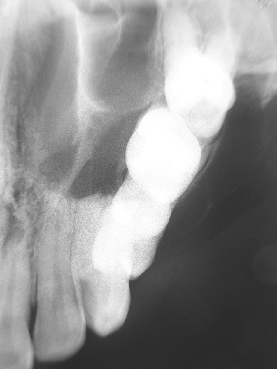 igure 5: Lateral maxillary occlusal radiograph with multilocular with