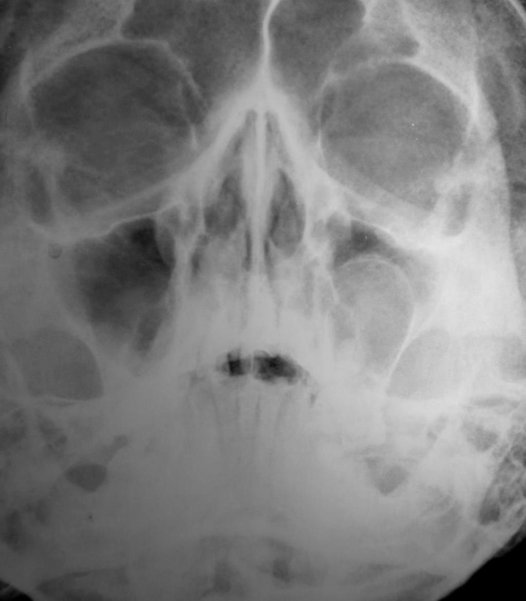 igure 6: Cropped paranasal sinus view revealing