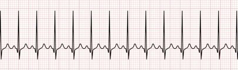 Tachycardia Fast heart rate above 100 beats per