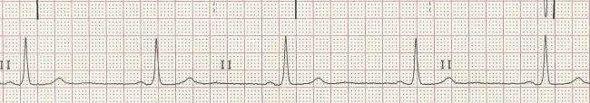 Bradycardia Slow heart rate below 60 B.P.