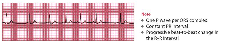 Sinus Arrhythmia The heart rate increases with inspiration & decreases with expiration