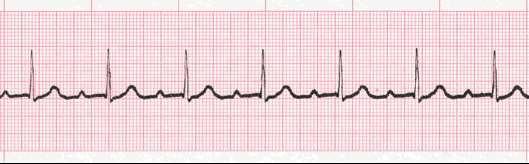 First Degree Heart Block when the PR interval increases to greater than 0.