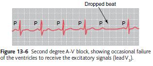 Second Degree Block Occurs when the P-R interval length is 0.25-0.