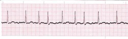 Atrial fibrillation The normal regular electrical impulses generated by the SA node are overridden by disorganized electrical impulses usually originating in the roots of the