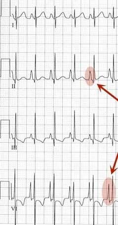 P wave Abnormalities Right atrial enlargement results in a P wave