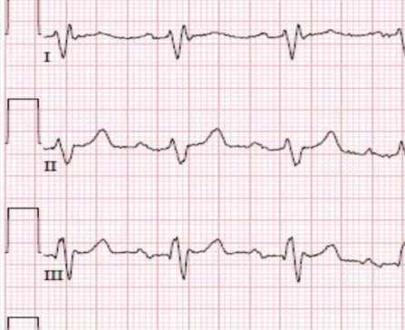 QRS Abnormalities Increased QRS width: Cardiac