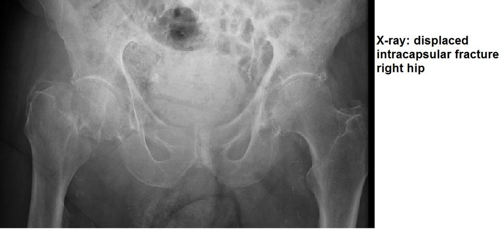 Complications of screw fixation include infection, non-union, loss of position and femoral head AVN (if painful, requires total hip replacement).
