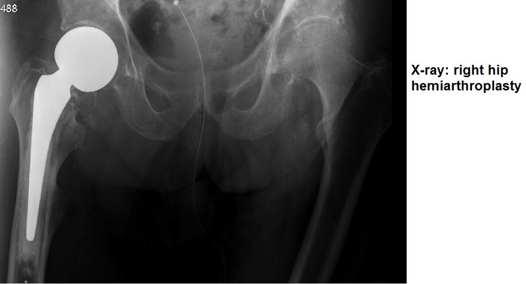 Extracapsular hip fractures The fracture line is distal to the insertion of the capsule and therefore there is no risk of AVN.