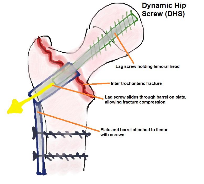 femoral head and can slide down through plate barrel (yellow arrow on diagram), allowing the fracture to compress and