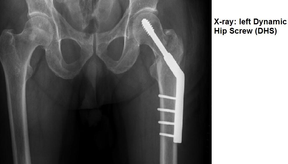 Subtrochanteric fractures are inherently unstable due to the position of the fracture and require fixation with a femoral intramedullary nail.