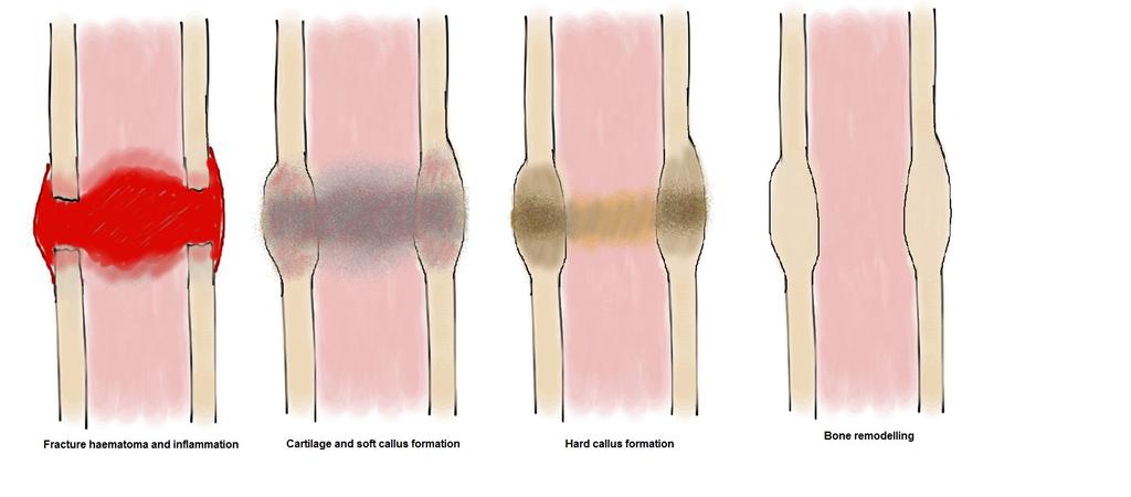 The process of healing occurs in 4 stages: 1. Haemorrhage and haematoma formation - bleeding into the fracture site leads to haematoma formation.