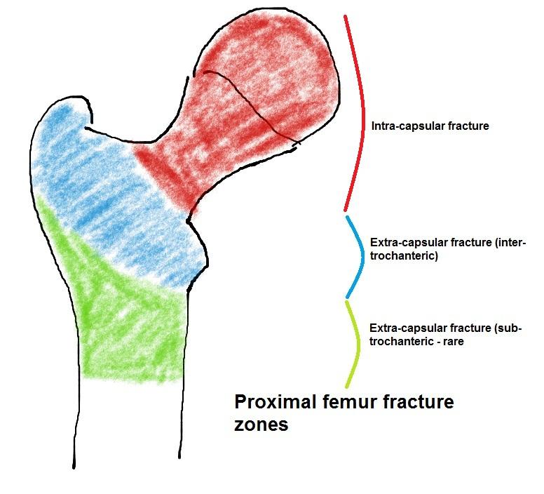 Common fractures Hip fractures Typically a fragility fracture (associated with osteoporosis) is seen in postmenopausal women over the age of 70 years.