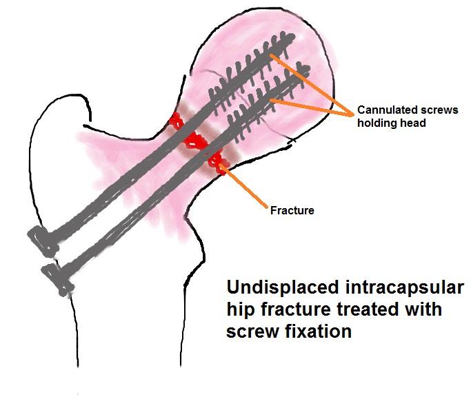 (arthroplasty). If entirely undisplaced, the head may be retained and fixed with screws (relying on the assumption that the lack of fracture displacement means the arteries are undamaged).
