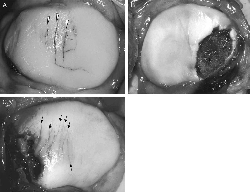 1030 E. Nomura and M. Inoue: Second-look arthroscopy of cartilage changes of the patellofemoral joint Fig. 1. Macroscopic findings of the patellar cartilage damage in APD (from Nomura et al. 10 ).