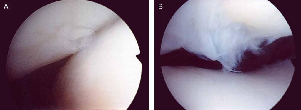 B: A second-look arthroscopy was performed 10 months after the first arthroscopy. Cracking on the central dome was the same as the initial condition.