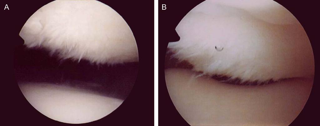 1034 E. Nomura and M. Inoue: Second-look arthroscopy of cartilage changes of the patellofemoral joint Fig. 7. A 40-year-old female of RPD.