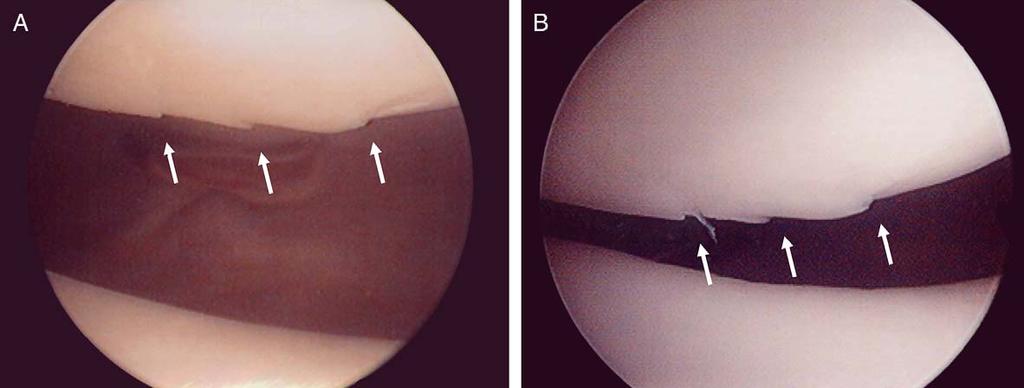 B: A second-look arthroscopy was performed 49 months after the first arthroscopy. Ulceration (erosion) became fibrillated, but cracking did not change. was considered to be essential.