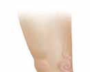 Varicose Veins Varicose veins are a common vein problem. They occur when superficial veins become dilated and bulge under the skin.