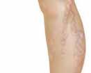 If varicose veins are a cosmetic concern or cause you discomfort, treatment can help. Symptoms of Varicose Veins Varicose veins stand out under the skin.