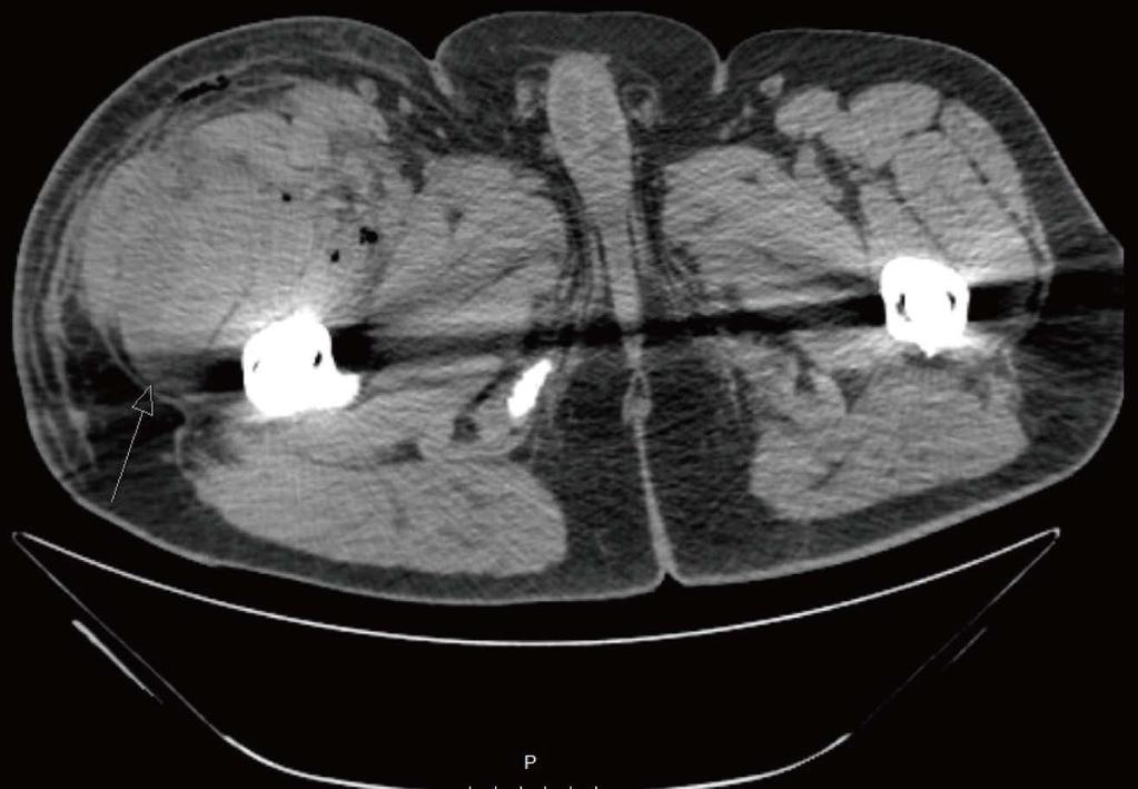 Hogerzeil DP et al. Compartment syndrome after total hip replacement Figure 3 Transverse plane computed tomography scan showing a hematoma dorsally in the anterior compartment.