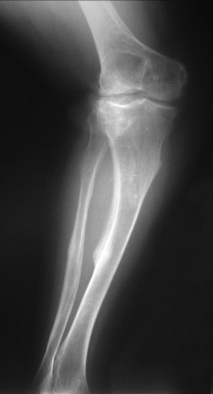 Deformities were first corrected with the use of a monolateral fixator (Orthofix LRS, Verona, Italy) and then stabilised with an intramedullary nail (Ortopro Retrograde Femoral and Tibial Nail G,