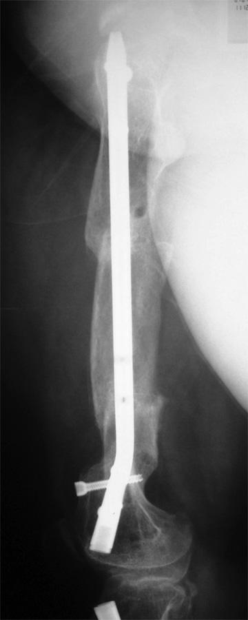 The nail was inserted slowly to reduce the risk of fat embolism, and locked both proximally and distally if no lengthening was planned.