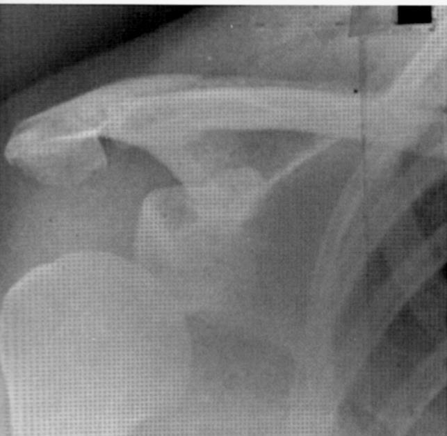 Anterior Shoulder Instability Anterior shoulder instability typically results from a dislocation injury to the shoulder joint when the humeral head (ball) of the humerus (upper arm bone) is displaced
