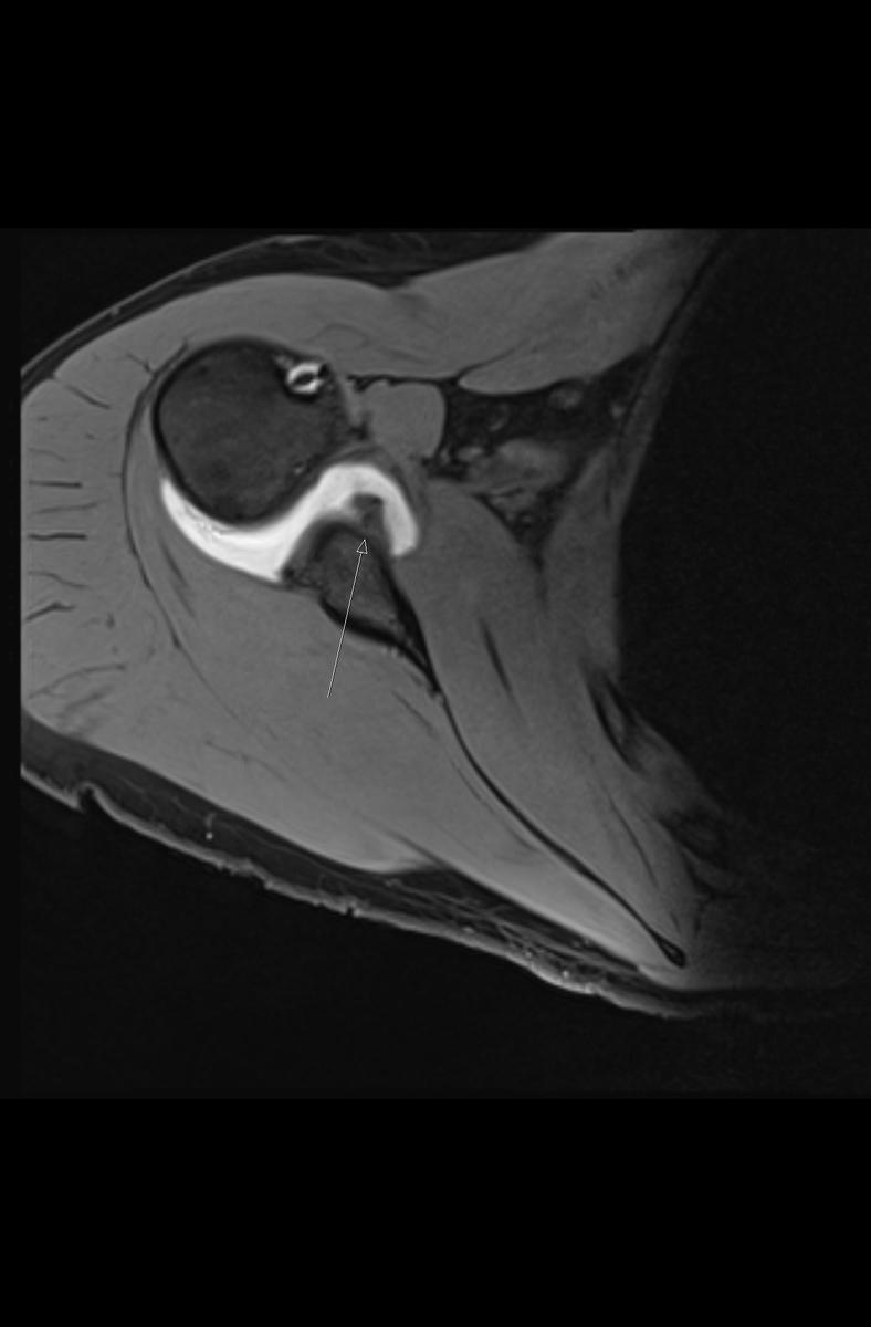 Fig. 5: Axial T1FS shows an ALPSA lesion with medialisation of the displaced glenoid labrum