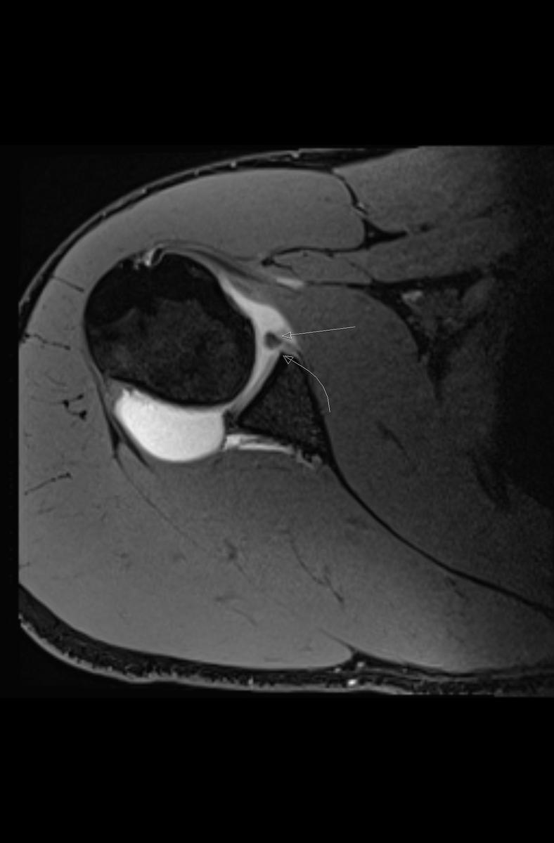 Fig. 6: Axial T1FS demonstrates an anteroinferior labral tear (straight arrow) with an associated chondral