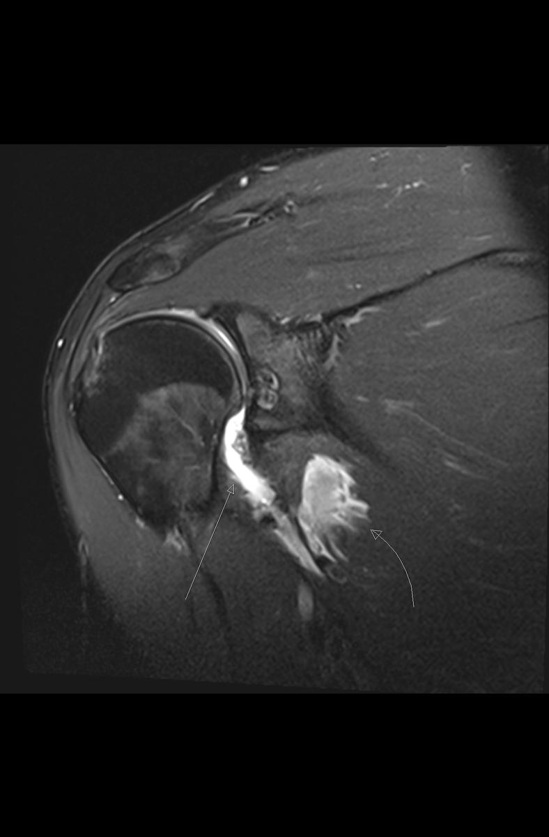 Fig. 8: Coronal PDFS with a HAGL shows characteristic 'J' morphology of the inferior glenohumeral