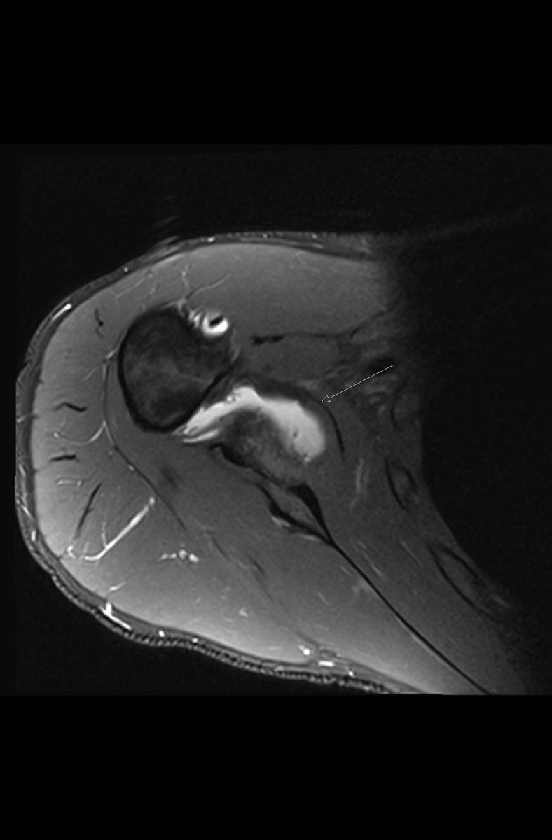 Fig. 9: Axial PDFS in the same patient shows altered morphology of the axillary