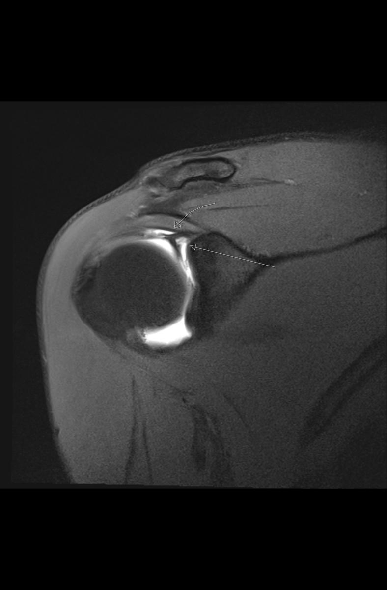Fig. 10: Coronal PDFS demonstrates a Type II SLAP tear with contrast entering the space between the superior labrum and
