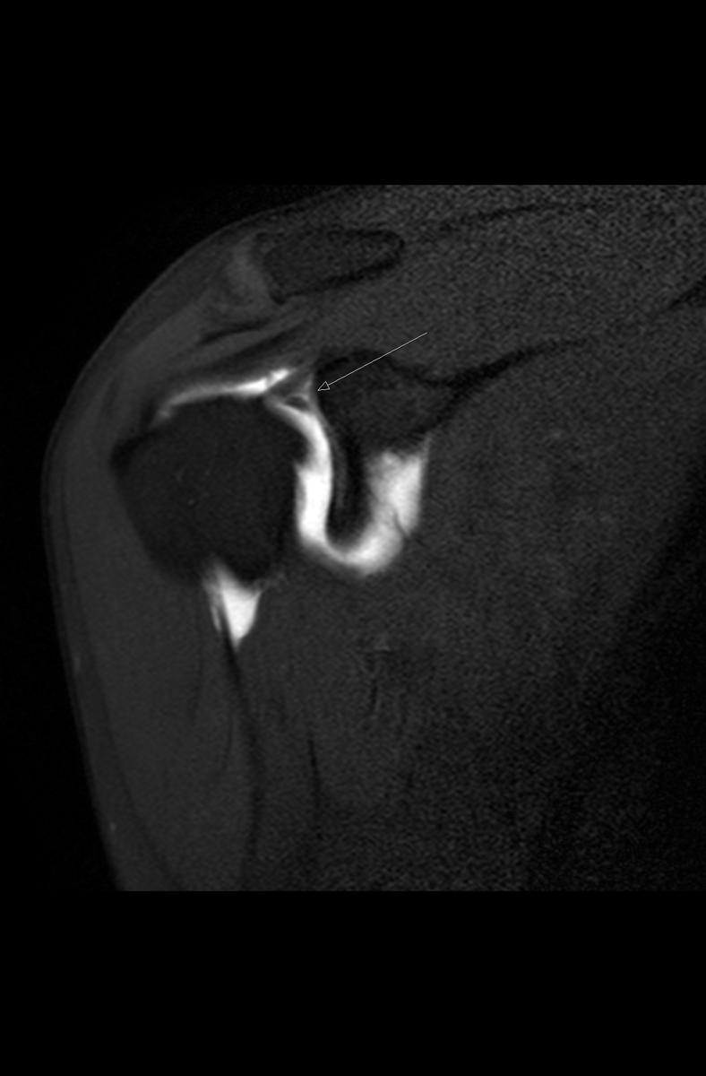 Fig. 11: Coronal PDFS in a different patient demonstrates a type III slap tear with contrast