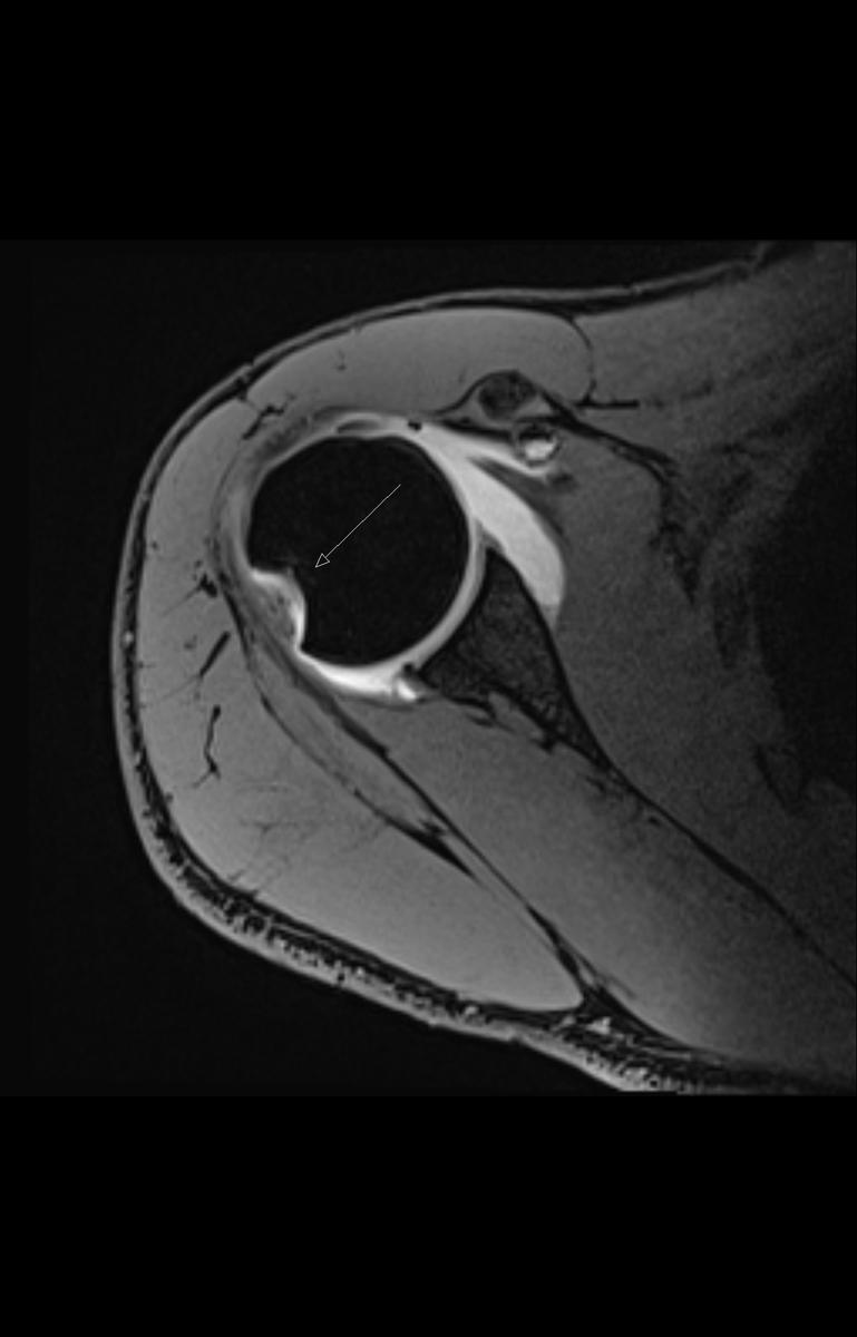 Fig. 13: Axial T1FS demonstrates a large defect in the posterosuperior