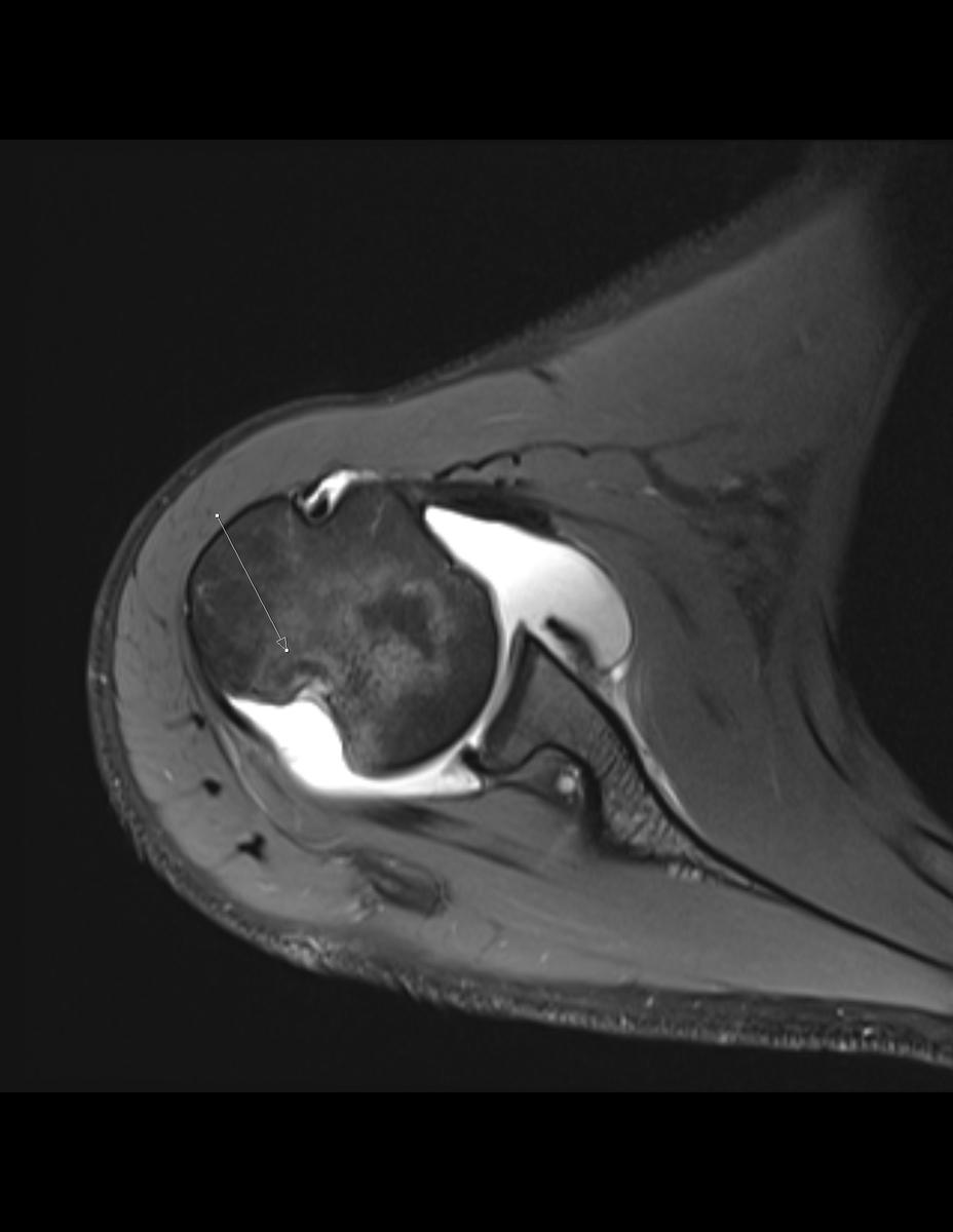 Fig. 14: Axial PDFS demonstrates a Hill Sachs defect in the humeral head with