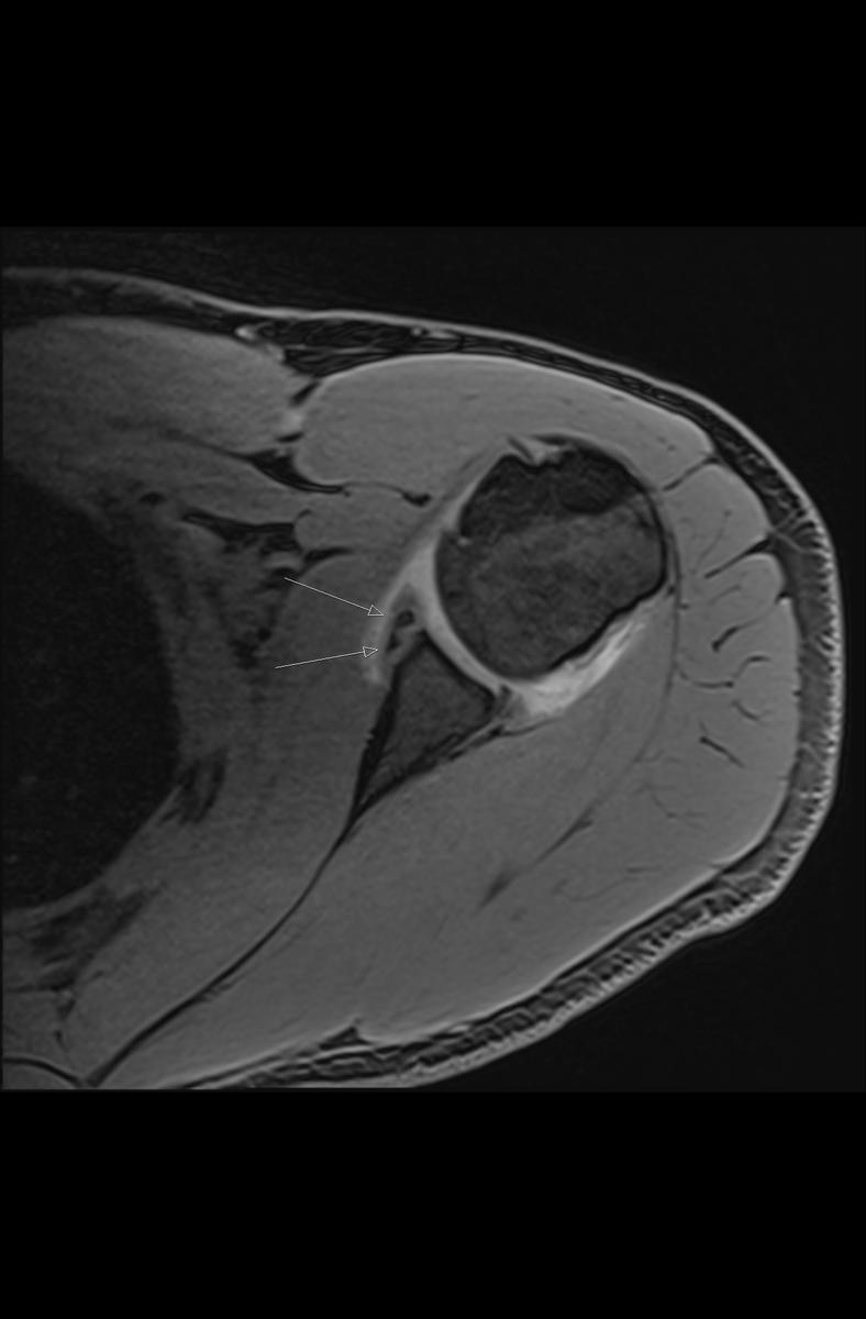 Fig. 2: Axial T1FS shows a bony Bankart lesion with avulsion of the glenoid labrum
