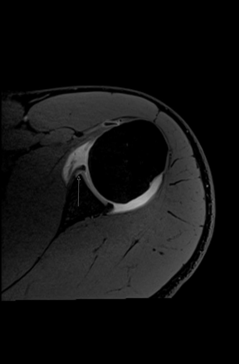 Fig. 3: Axial T1FS shows an avulsion of the anteroinferior labrum which remains attached by intact
