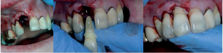 PART II. IF DENTAL INJURY OCCURS Managing Avulsion(6) Dental Emergency!