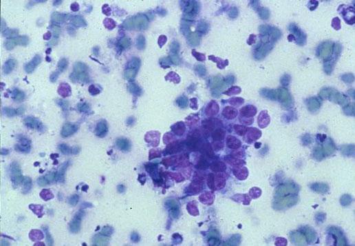 Cytology Basaloid Cells Shadow cells singly and in clusters (ghost squamous