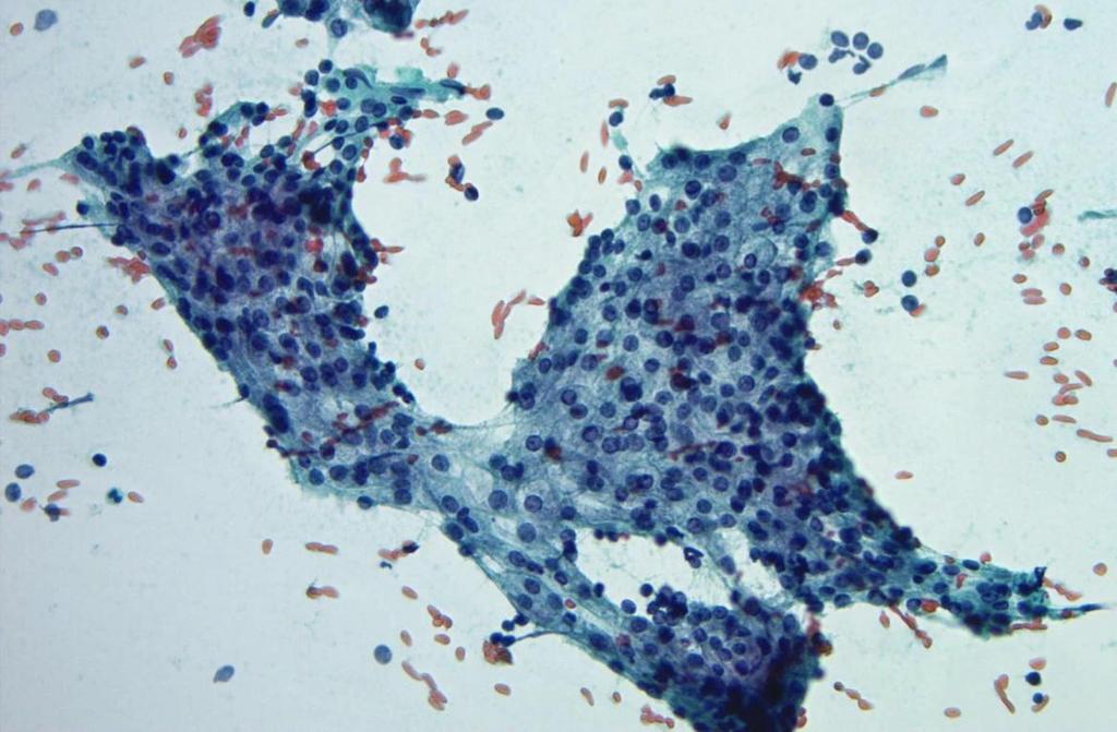 Acinic Cell CA Low grade malignancy
