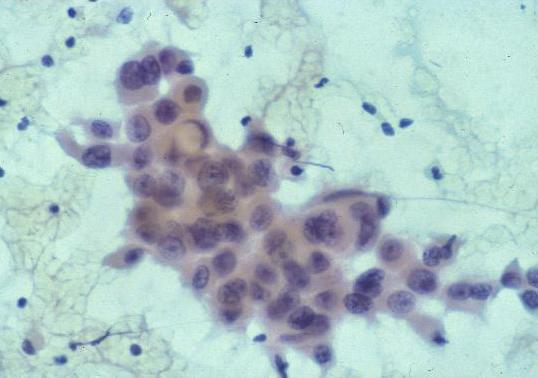 Cytology Large pleomorphic cells with
