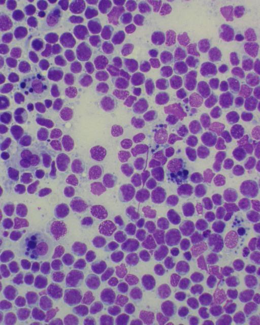 or leukemia Large B cell (35%),