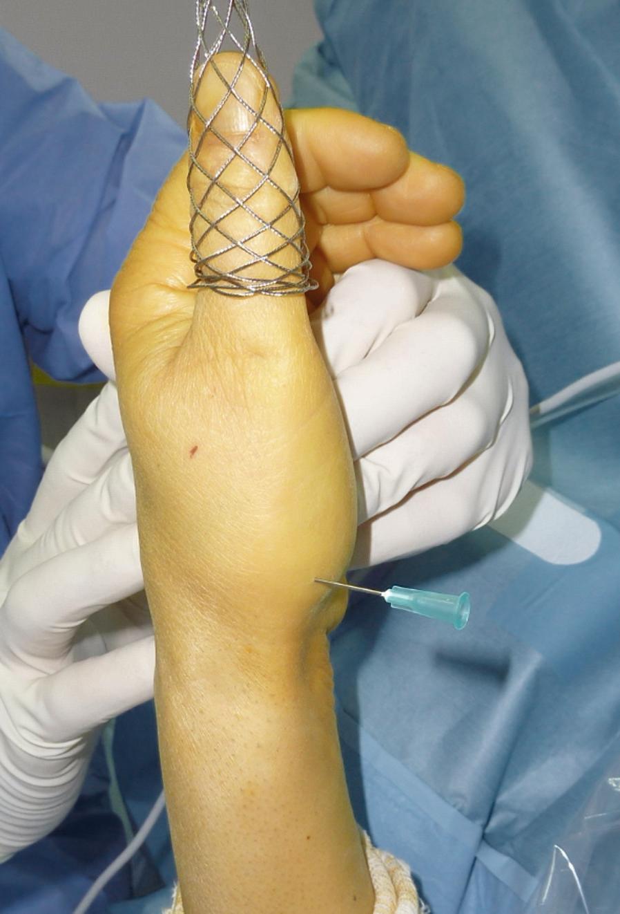 Chapter 24 Arthroscopic Thumb Carpometacarpal Interposition Arthroplasty Introduction Osteoarthritis in the thumb carpometacarpal (CMC) joint is a common condition, especially in women over 60 years